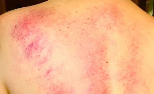 Imagen de Mastocitosis 