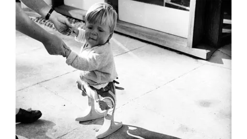 Fotografía de un bebé afectado por la talidomida