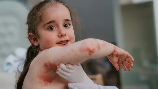 Niña con Piel de Mariposa