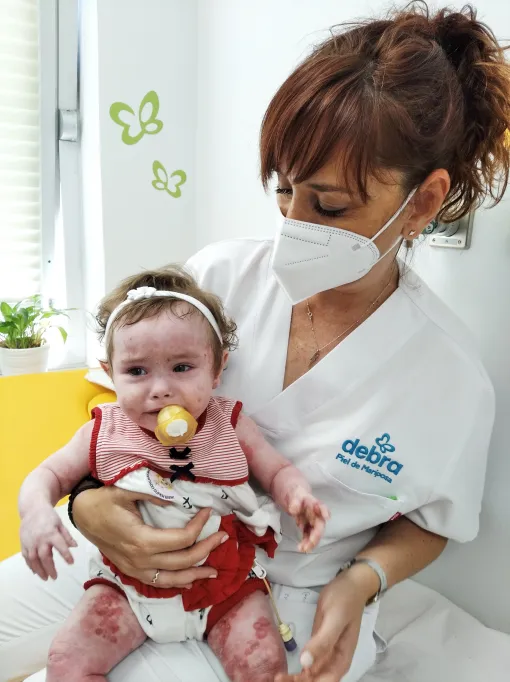 Enfermera atiende a un bebé con Piel de Mariposa